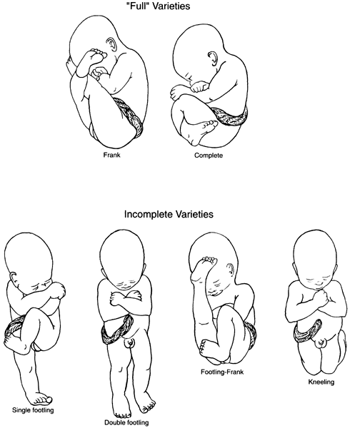 meaning of abnormal fetal presentation