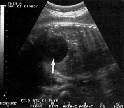 ultrasound images of renal tumors