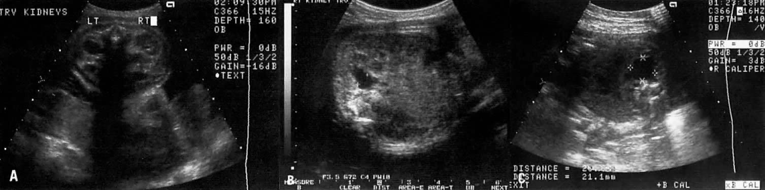 ultrasound pictures of healthy kidney