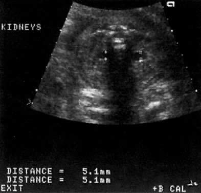 ultrasound images of renal tumors