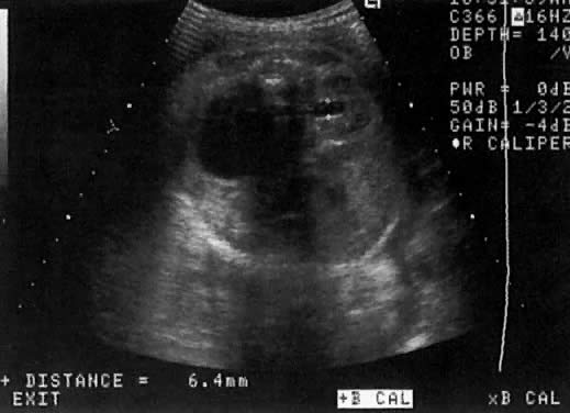 ultrasound pictures of kidney tumors