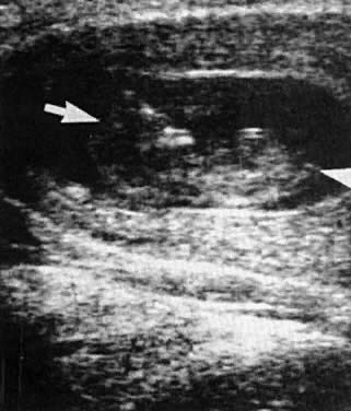 Gestational determine age to ultrasound 