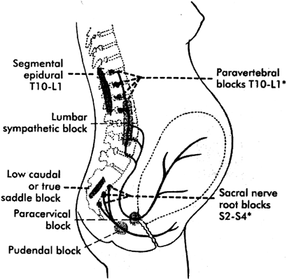 Analgesia and Anesthesia for Labor and Delivery