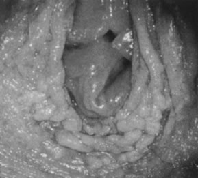 Squamous papilloma genital