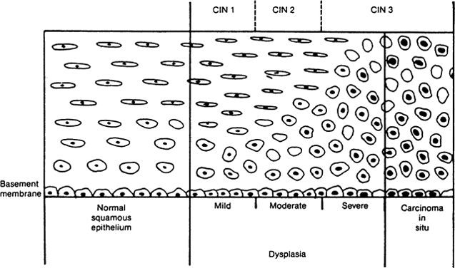 Cervical Intraepithelial Neoplasia Grade 1