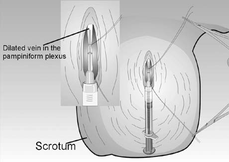 Saline Injections Scrotum
