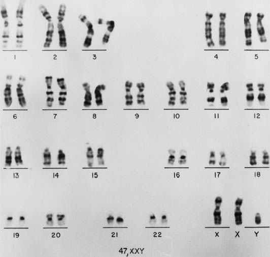 xxy chromosome female