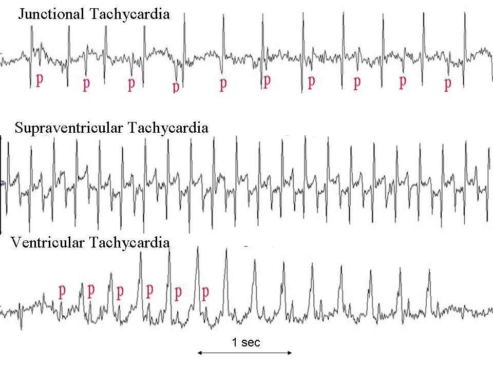 Fetal Arrhythmias Glowm