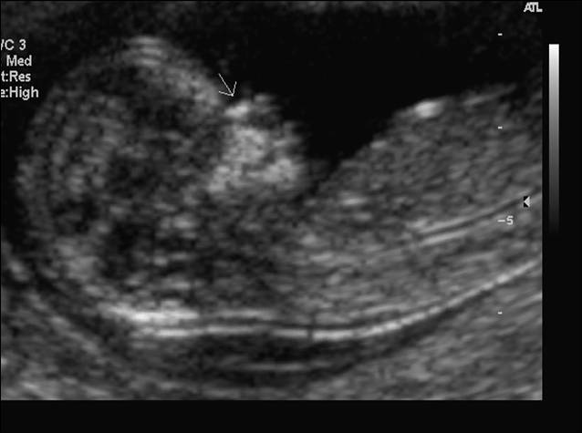 trisomy 21 ultrasound