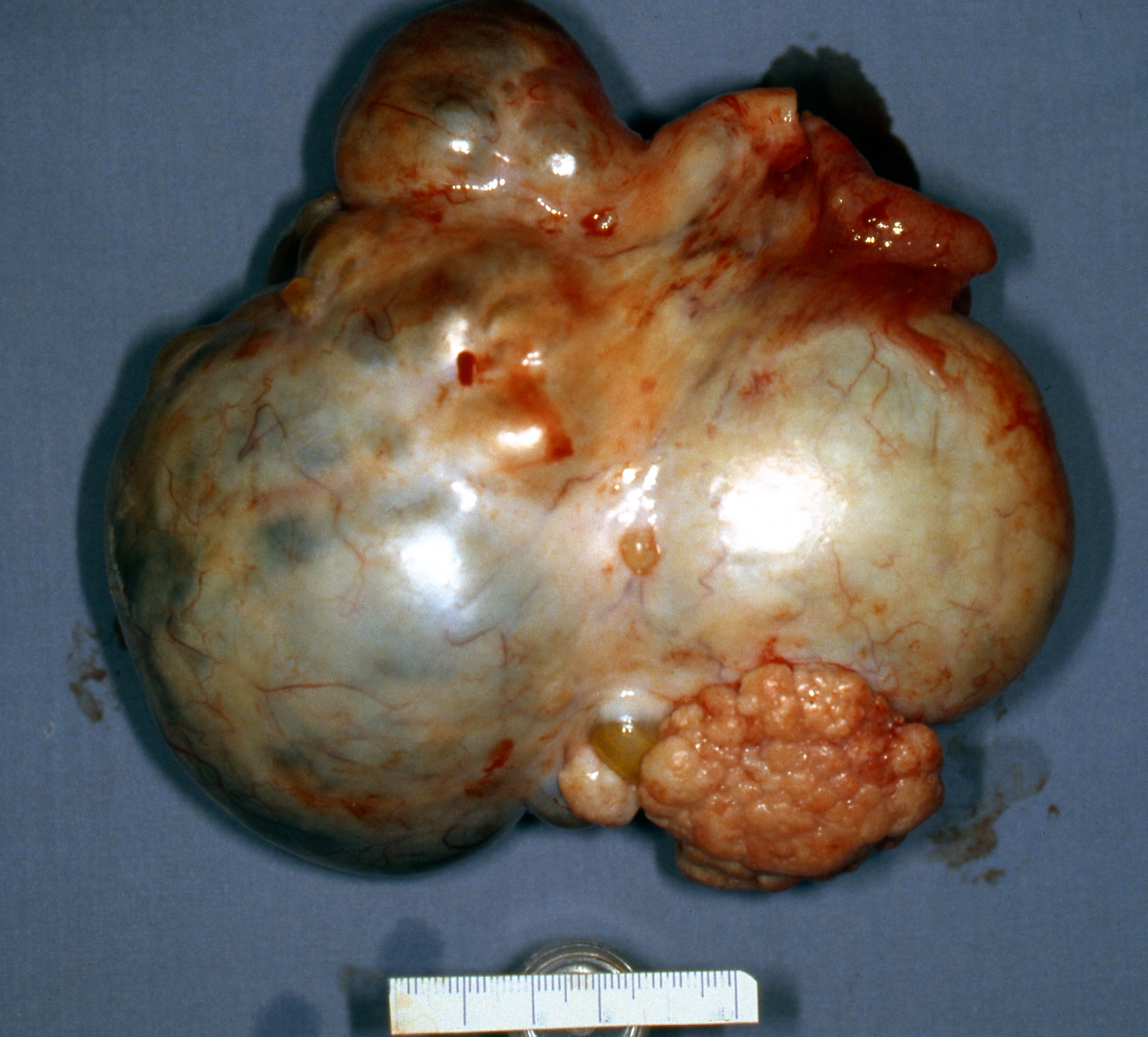 cancer ovarian neoplasm