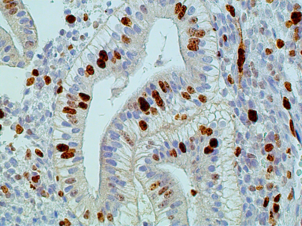 Экспрессия ki67. /Ki 67 Cancer cervix IHC.