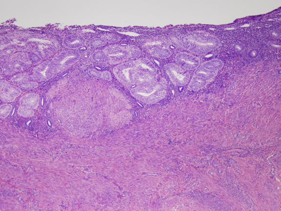 Hyperplasia and atypical hyperplasia