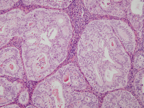 Histology secretory endometrium Endometrial hyperplasia