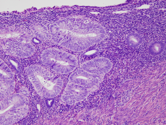 Pathology of the endometrium