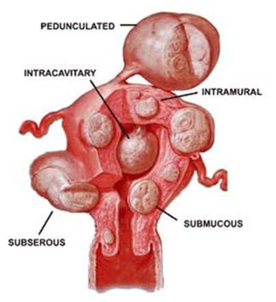 how fibroids are measured