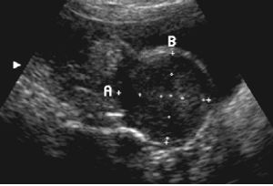 uterus fibroid ultrasound