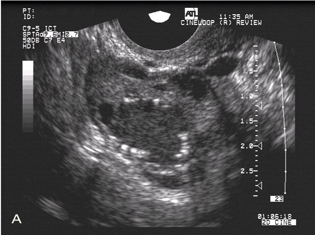 A–C) Sonograms of the dominant follicle (Ø 22, 32 and 38 mm) in a