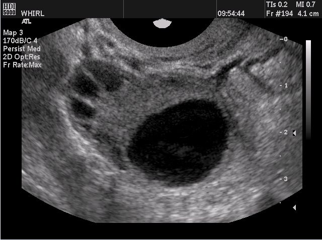 A–C) Sonograms of the dominant follicle (Ø 22, 32 and 38 mm) in a