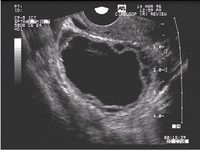 graafian follicle ultrasound