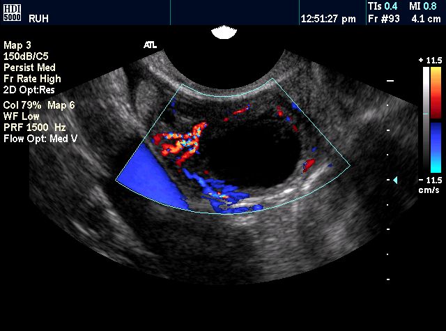 healthy ovarian ultrasound