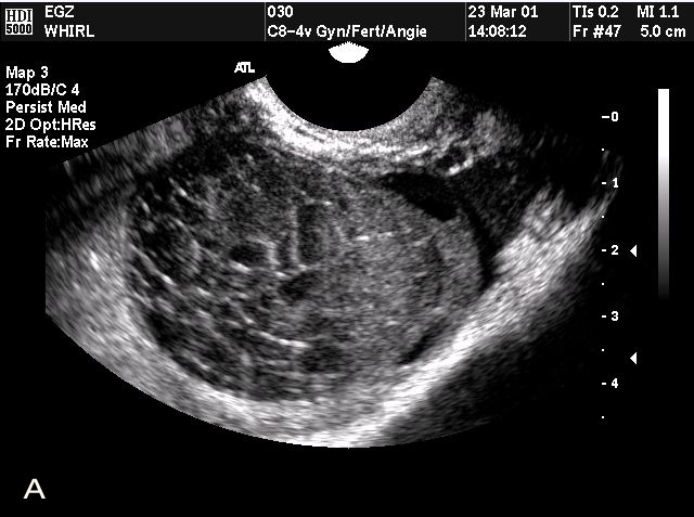 graafian follicle ultrasound