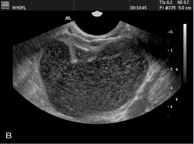 Transvaginal ultrasonography and female infertility