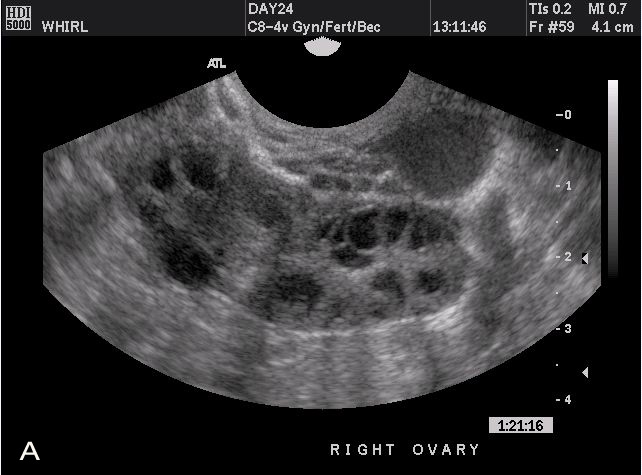 Transvaginal ultrasonography and female infertility