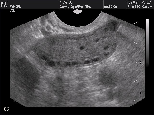 Transvaginal ultrasonography and female infertility