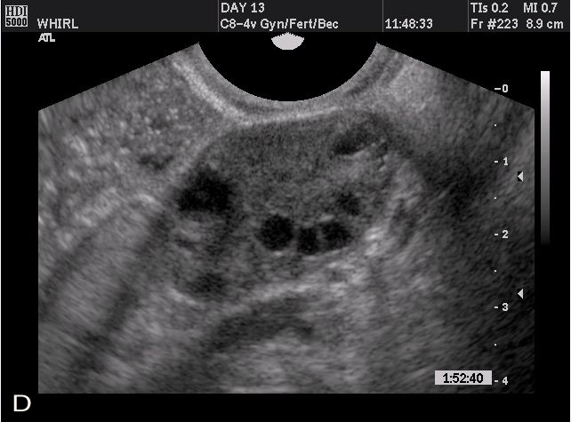 Vaginal ultrasonography versus endometrial biopsy in women with