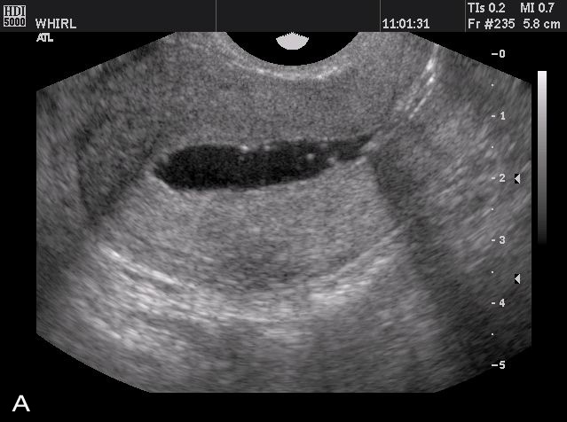 Transvaginal Ultrasonography And Female Infertility Glowm