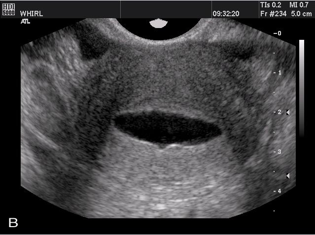 Transvaginal Ultrasonography And Female Infertility Glowm