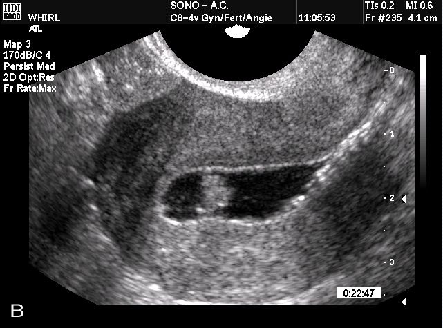 Blood Clot In Uterus During Early Pregnancy - PregnancyWalls