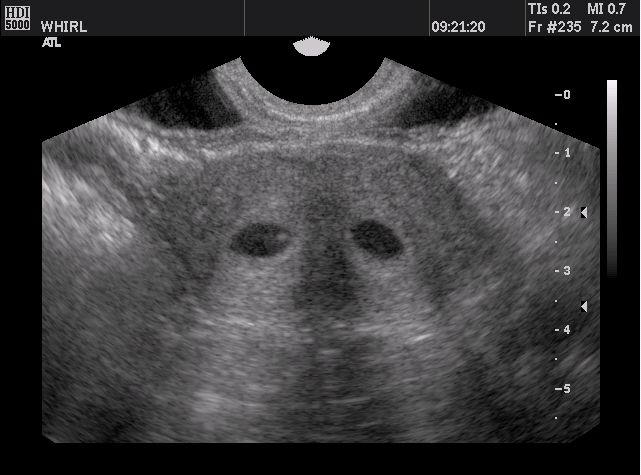 Normal Uterus Transvaginal Ultrasound 9991