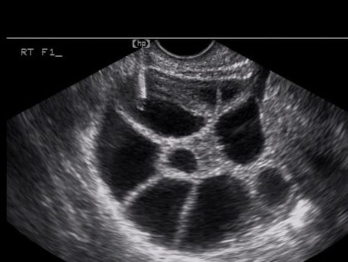 abnormal transvaginal ultrasound