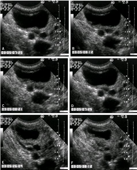 Baseline transvaginal ultrasound scan in patient 1 showing an AFC of 60