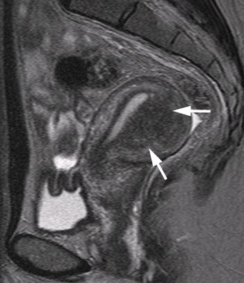 Angiogenesis is a feature of endometriosis and adenomyosis.