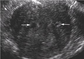 Adenomyosis Glowm