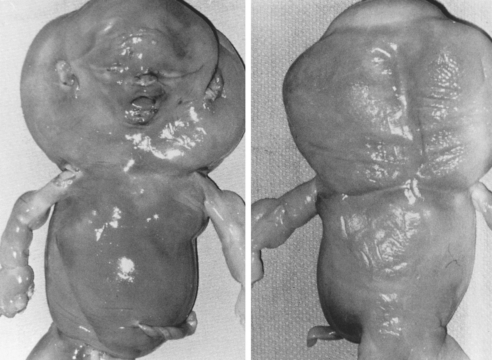 Chromosomal Abnormalities in Pregnancy