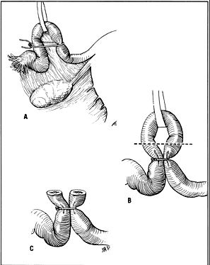 Postpartum Tubal Sterilization: Overview, Technique