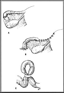 Postpartum Tubal Sterilization: Overview, Technique