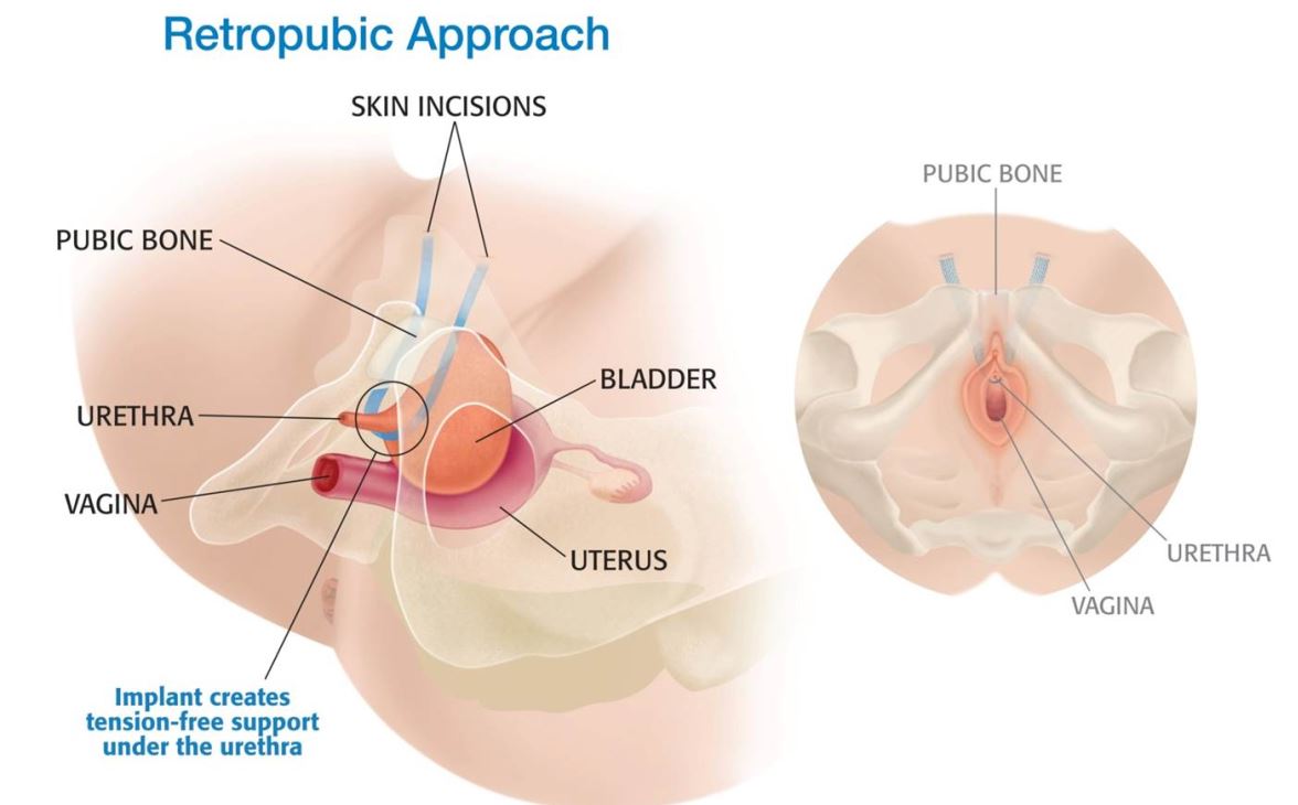 Bladder Sling Complications  Pain, Mesh Erosion & Perforation