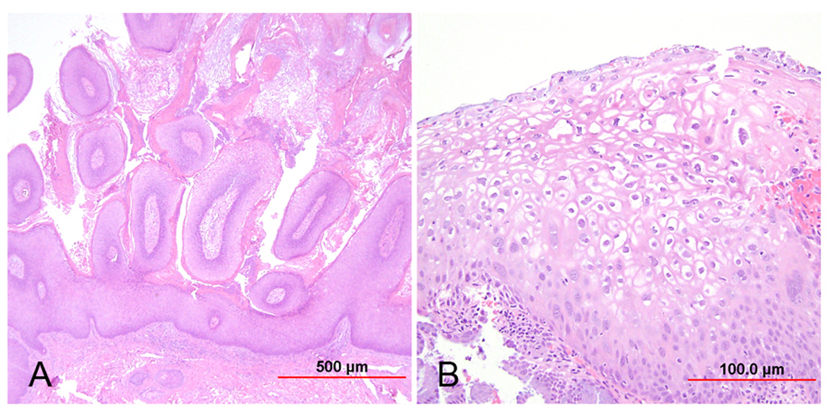 Mi a cervicitis condyloma