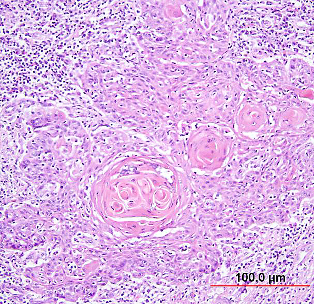 Carcinoma In Situ De Cervix Clinical Presentation Stages And Treatment Of Cervical Cancer