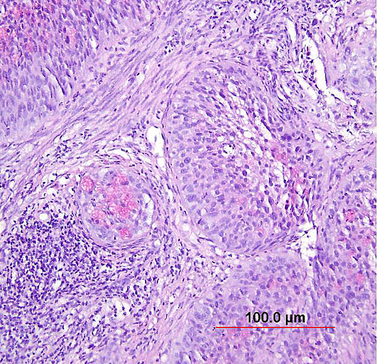 Pathology Of Cervical Carcinoma GLOWM