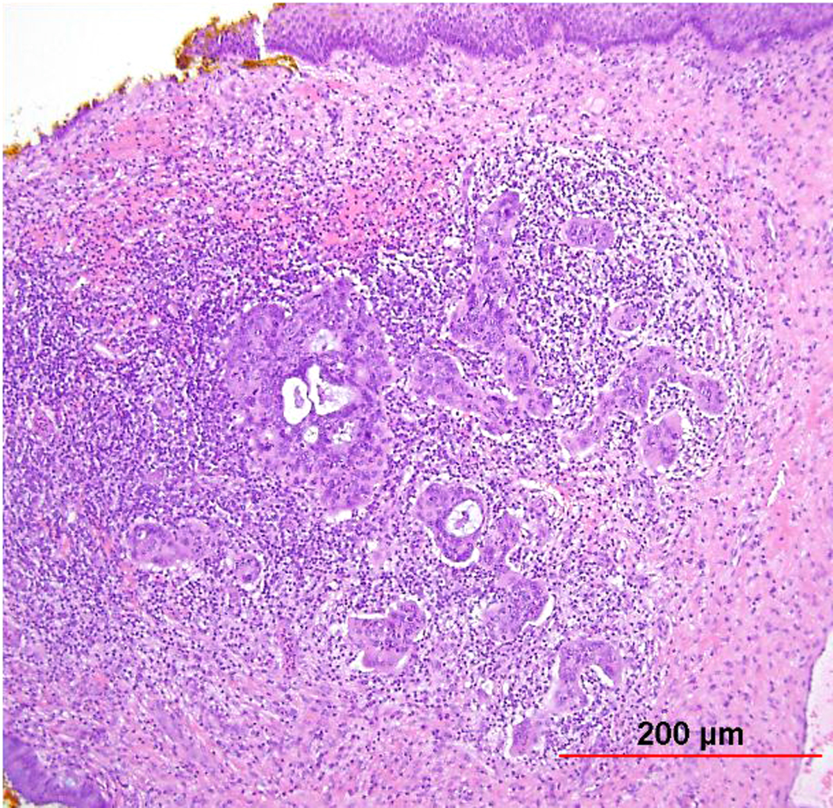 papilloma planoepitheliale w przelyku szemölcsök a húgycső közelében nőknél