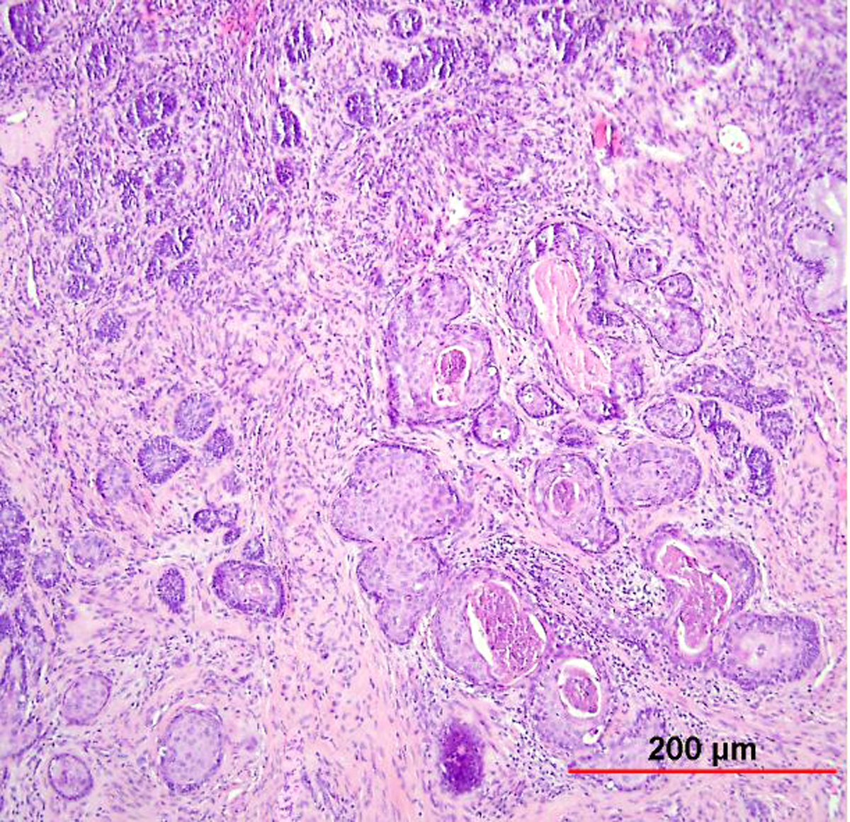 adenoid basal cell carcinoma histology