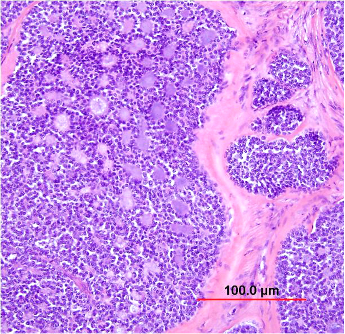 Cervical Carcinoma Histology