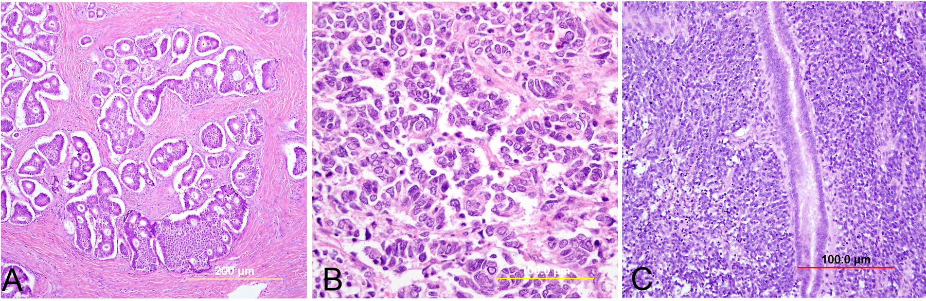 Pathology Of Cervical Carcinoma Glowm