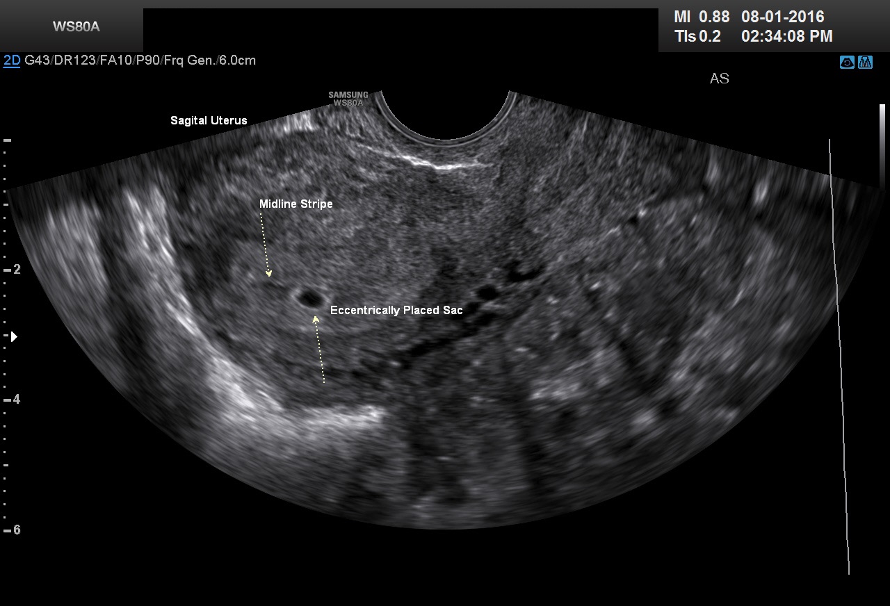 Ultrasound trimester normal first 