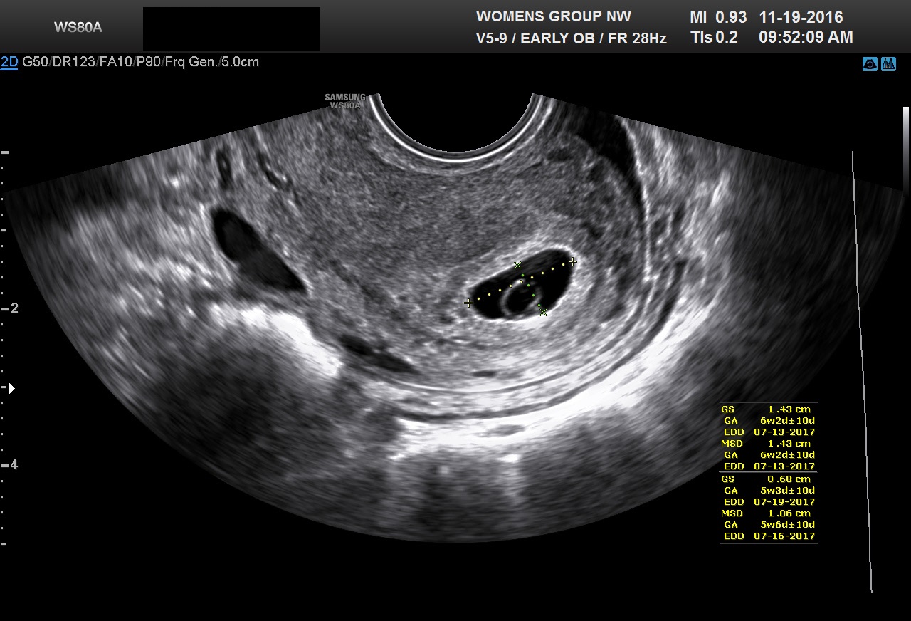 Gestational Sac Measurement Ultrasound